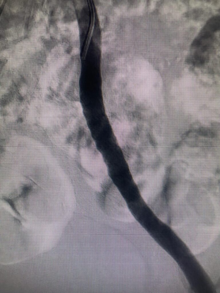 Endofibrosis en un ciclista profesional